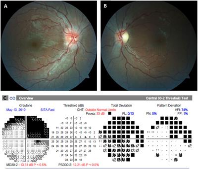 Pediatric autoimmune retinopathy and optic neuropathy: a case report and a review of the literature